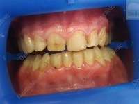 Direct Composite veneers 